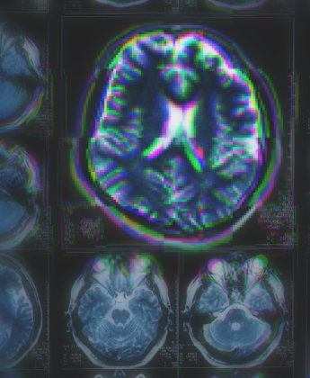  Neurodegenerative